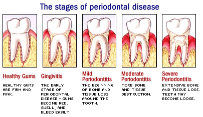 mild periodontitis